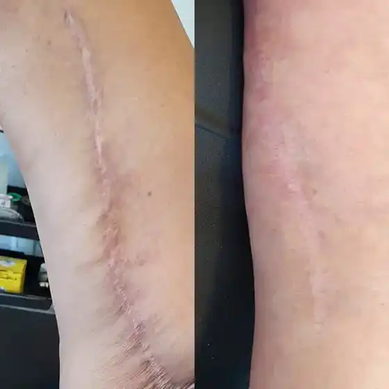 Antes/Depois - Cicatriz de cirurgia