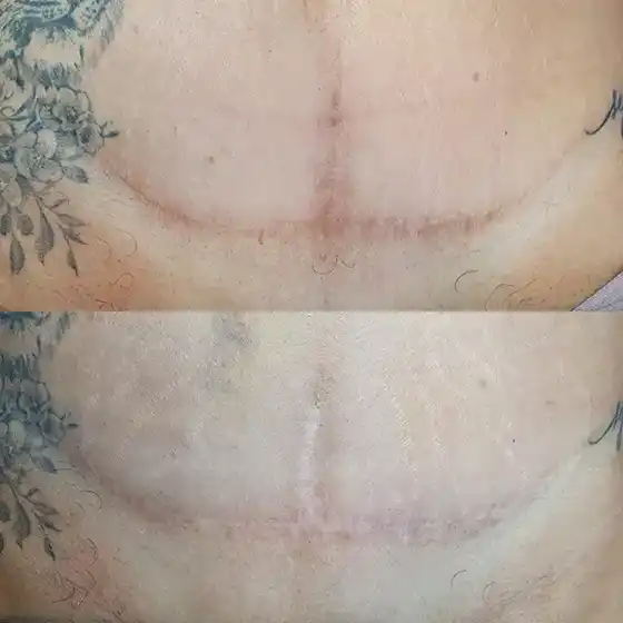 Antes/Depois - Cicatriz de abdominoplastia