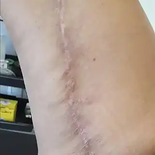 Cicatriz de cirurgia